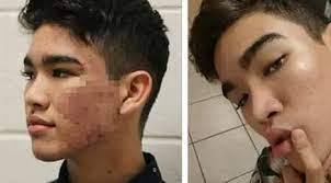 Juga membuat lo terhindar dari kulit. Tips Menyembuhkan Jerawat Ala Remaja Ini Viral Hanya Pakai Produk Murah Lifestyle Fimela Com