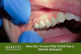 Image result for Periodontal Abscess