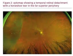 An optos® retinal exam provides: The Impact Of Ultra Widefield Retinal Imaging On Practice Efficiency Touchophthalmology