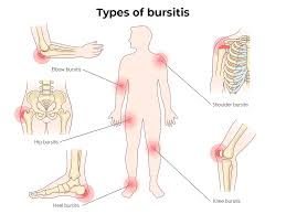 Image result for Bursitis