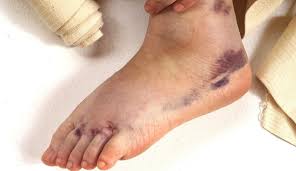 Maybe you would like to learn more about one of these? Sapu Dengan Minyak Selepas Kaki Terseliuh Rupanya Cara Salah Ini Yang Sepatutnya Kita Buat Maskulin