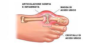 La gotta è una malattia ricorrente comune, che è accompagnata da una maggiore deposizione di sali di urato all'interno delle articolazioni e nei reni. Gotta Sintomi E Rimedi Naturali Per Alleviare I Dolori Ambiente Bio
