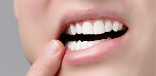 Aphthen Wie Man Gegen Die Kleinen Blaschen Im Mund Vorgehen Kann Zwp Online Das Nachrichtenportal Fur Die Dentalbranche