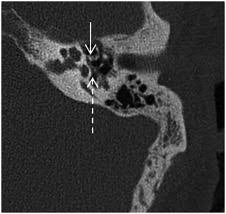 Image result for Myringosclerosis