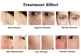 See more ideas about hair removal cream, hair removal, acne. 808nm 810nm Diode Laser Hair Removal Age Spot Removal Acne Treatment Machine Diode Laser Epilation Professional Laser Manufacturer China 808nm Diode Laser Age Spot Removal Made In China Com