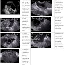 Vaginal ultrasound can help to show whether any cysts on your ovaries contain cancer or not. Update On The Differential Diagnosis Of Gynecologic Organ Related Diseases In Women Presenting With Ascites Sciencedirect