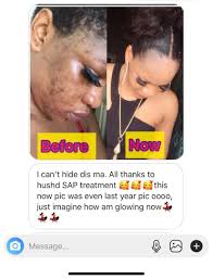 Our Sap face treatment pack remains the undefeated champion to pimples,  acne and spots. Dealing with same issue? Get yours via our website  www.hushdng.com/shop or speak to our representative through 070-000-22222.  Hush'D....