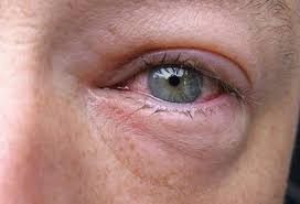 Mucormycosis is an unusual fungal infection that causes symptoms and signs that range from vision problems and headache to cough, pneumonia, and skin ulcers. à¤• à¤° à¤¨ à¤• à¤  à¤• à¤¹ à¤ à¤®à¤° à¤œ à¤® à¤… à¤§ à¤ªà¤¨ à¤• à¤• à¤°à¤£ à¤¬à¤¨ à¤°à¤¹ Black Fungus à¤œ à¤¨ à¤• à¤¨ à¤² à¤— à¤• à¤¹ à¤œ à¤¯ à¤¦ à¤–à¤¤à¤° 10 à¤²à¤• à¤·à¤£