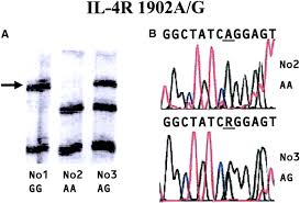 Polymorphisms Of Interleukin 4 Related Genes In Japanese Children With Minimal Change Nephrotic Syndrome American Journal Of Kidney Diseases