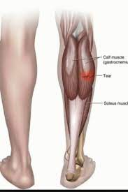 Leziunea musculara este rezultatul unor macrotraumatisme produse de o contractie brusca a unui muschi, in anumite conditii favorizante. Kineto Smart Ruptura Musculara Este Ruptura Care Poate Facebook