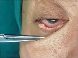 Image result for Sebaceous Hyperplasia