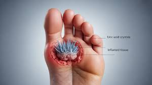 Image result for gout symptoms toe