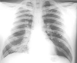 Pectus excavatum causes the breastbone to sink into the chest. Https Med Und Edu Radiology Files Docs Xray Film Reading Made Easy Pdf