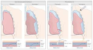 It can occur due to abnormal air sacs in the lungs that break apart and release if you have symptoms of a collapsed lung, go to the emergency room. Pneumothorax Amboss