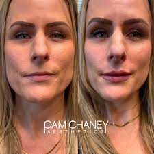 We love full face photos when showing lips so you can see that even though  they're more plump, they still look natural and proportionate to the face.  💉Treatment: Lip Filler 💋 👩‍⚕️Purpose: