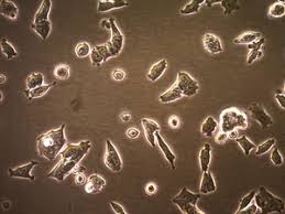 Risks associated with a prostate biopsy include: Cwr R1ca Human Prostate Cancer Cell Line Cwr R1ca Human Prostate Cancer Cell Line Is A