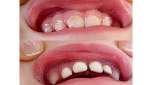 There must be enough tooth structure for the crown to adhere onto. Dental Crown Types Procedure When It S Done Cost And Aftercare