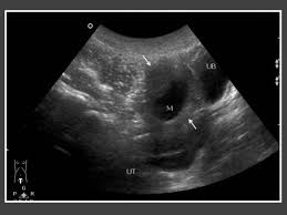 Female pelvic ultrasound phantom (transvaginal) the pelvic phantom is unique in that it allows for transabdominal and transvaginal scanning. Four Year Old Girl Who Presented With Per Vaginal Bleeding Transverse Download Scientific Diagram