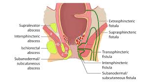 According to the american cancer society, just over 100,000 new cases of skin cancer are diagnosed in the united states each year. Anal Abscess And Fistula Knowledge Amboss