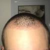 The hair which is shed generally grows back together with the transplanted hair beginning at about three months. 1