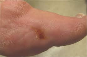 I had orange spots on the panel that covers the passenger airbag when i purchased my truck. What Is Your Diagnosis Stinkbug Staining Mdedge Dermatology