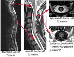 Krankheitsschübe wie auch läsionen in der magnetresonanztomographie (mrt) reflektieren den krankheitsprozess bei der… teriflunomid reduziert den jährlichen verlust an hirnvolumen frankfurt, 02. Diagnosing Transverse Myelitis Tm Johns Hopkins Transverse Myelitis Center