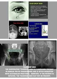 A Tear Drop Or Tear Drop Sign Is Found In Several Regions Of The Body Pelvic Tear Drop Ankle Tear Drop Sign Tear Human Anatomy And Physiology Radiology Signs
