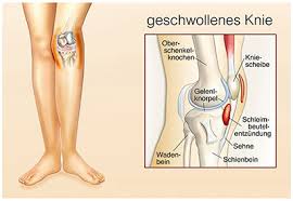 Schleimbeutelentzundung Bursitis Ursachen Symptome Behandlung Medlexi De