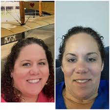 Gastric sleeve surgery progress and diet after surgery