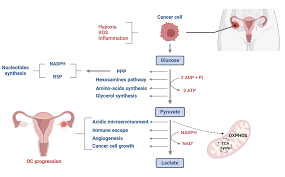 Alteration of glucose metabolism and expression of glucose transporters in  ovarian cancer