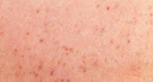Ingrown hair cyst identification removal and more. Depileve Trapped Hair Find Out How To Prevent And Treat It
