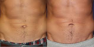 Nj Umbilical Hernia Patient New Jersey Plastic Surgeons Fort Lee