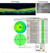 Presumed Ocular Histoplasmosis Pohs Eyerounds Org
