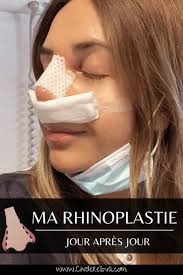 Le comblement du dorsum nasal nécessite pour se faire des greffes de cartilage en quantité importante afin de reconstruire un profil adapté à ce. Rhinoplastie Mon Experience Jour Apres Jour