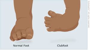 Clubfoot definition clubfoot is a condition in which one or both feet are twisted into an abnormal position at birth. Clubfoot For Parents Nemours Kidshealth