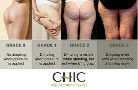 A wide variety of cellulite g5 massage options are available to you, such as function, feature, and application. Anti Cellulite Skin Tightening Chic Med Aesthetic Clinics