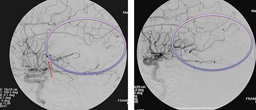 The Lazarus Effect | Neurological Surgery