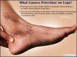 Senile purpura is usually seen on areas exposed to mild repeated trauma, such as the back of hands. Causes Of Petechiae On Legs Pet S Gallery