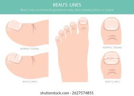Image result for Beau lines feet