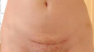 If you wax regularly, you'll lower your chance of getting an ingrown hair. Industrijski Sesija Udahnite Ingrown Hair Bikini Line Cabanalaescondida Com