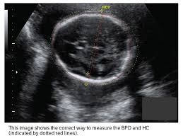 How Accurate Are Your Obstetric Measurements Obtaining Appropriate Measurements Is Critical For Obstetric Ultrasound Ultrasound Sonography Medical Ultrasound