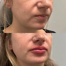 ✨ First-Time Lip Filler: What You Need to Know ✨ Thinking about lip filler  for the first time? 💉 Here's a quick breakdown of what to expect before,  during, and after your