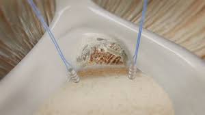 Image result for SLAP Lesion