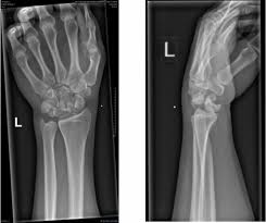 Image result for Lunate Dislocation