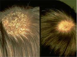 A few months after having a high fever or recovering from an illness, many people see noticeable hair loss. Hair Loss Who Gets And Causes