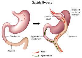 Some factors a patient may consider when choosing between a gastric bypass vs a sleeve gastrectomy. Gastric Bypass Vs Mini Gastric Bypass Tijuana Mexico Bariatric Surgery