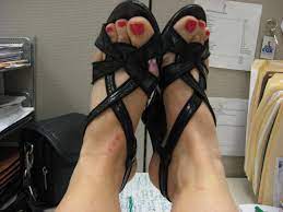 Pin On Skeeter Syndrome Pictures