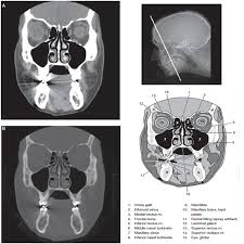 Image result for Sinus CT