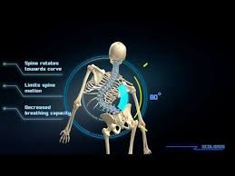 The correct scoliosis exercises depend on the location of the scoliosis curve. Scoliosis Animation Video Scoliosis Exercises Scoliosis Hip Flexor