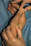 Image result for icd 10 code for right thumb ulnar collateral ligament tear